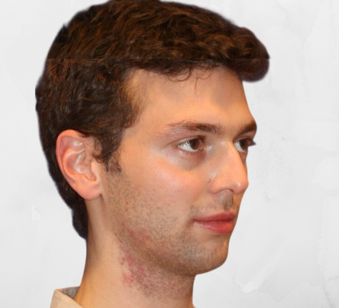 Avant traitement du visage homme