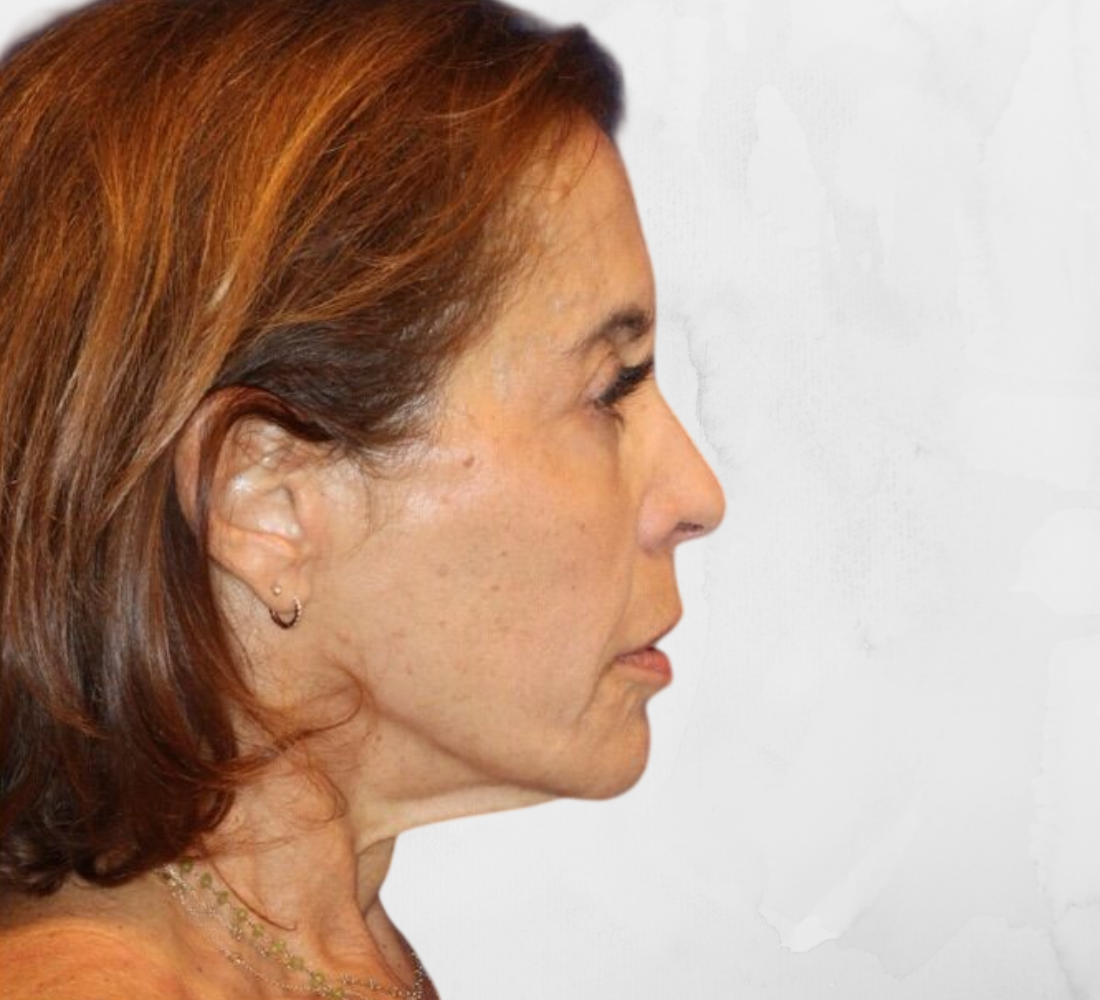 Après 3 mois de traitement du profil du visage femme